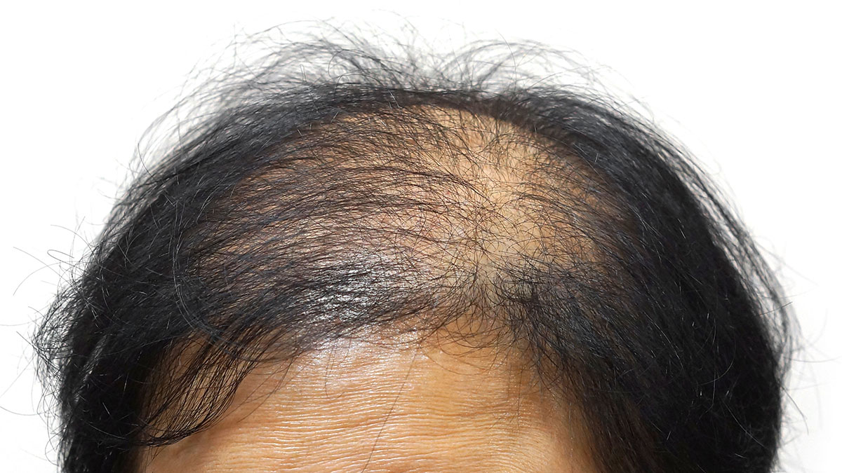 Knowing Your Bald Spot Treatment Options - Toppik Hair Blog
