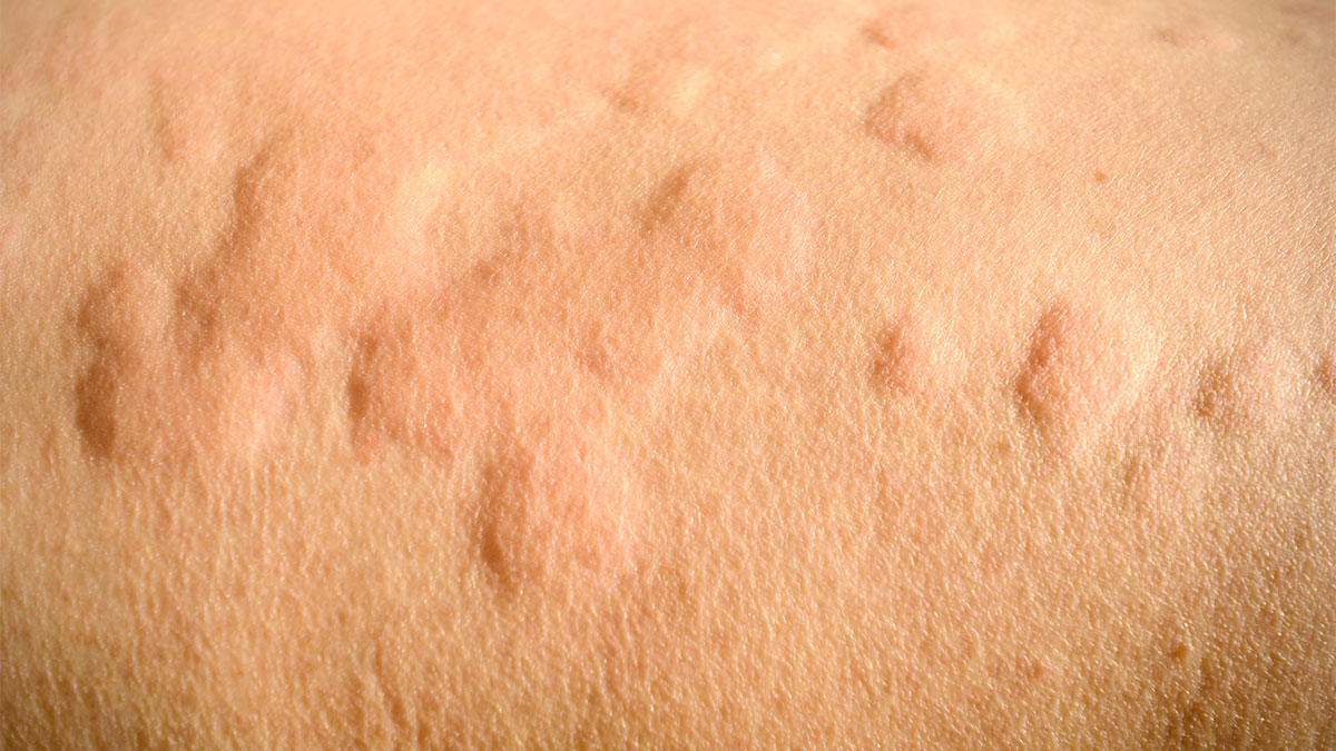 Urticaria Types